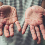 Спалах вірусу Коксакі зафіксовано на Київщині