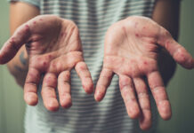 Спалах вірусу Коксакі зафіксовано на Київщині Вірус Коксакі