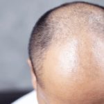 У Британії схвалили ліки від облисіння