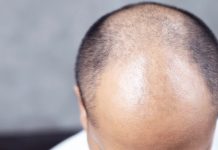 UK approves medicine for baldness Alopecia