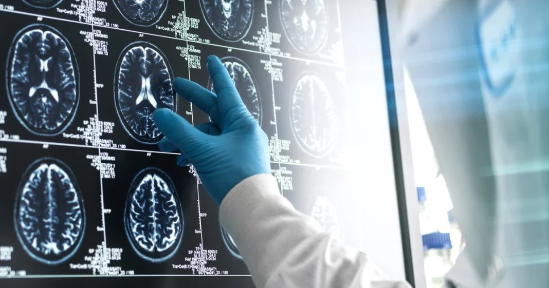 Research into new treatments for Alzheimer’s disease New drugs are already capable of slowing the progression of early-onset Alzheimer’s, and up to 45% cases of dementia could potentially be delayed