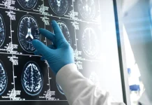 New drugs slow the progression of early-onset Alzheimer’s disease New drugs are already capable of slowing the progression of early-onset Alzheimer’s, and up to 45% cases of dementia could potentially be delayed