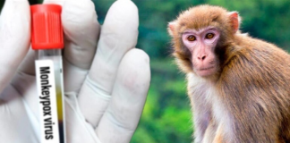 Monkeypox in Russia: new cases in St Petersburg
